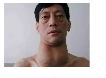 甲亢患者什么不能吃 甲亢患者什么不能吃