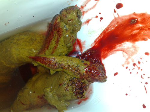 为什么大便带有血丝 为什么大便带有血丝