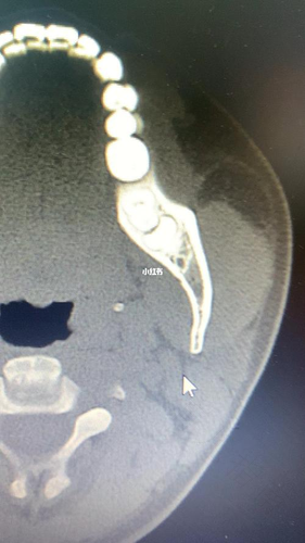拔智齿一定要拍ct吗 拔智齿一定要拍ct吗