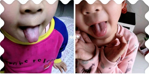 儿童舌苔厚白口臭怎么治吃什么药 儿童舌苔厚白口臭怎么治吃什么药