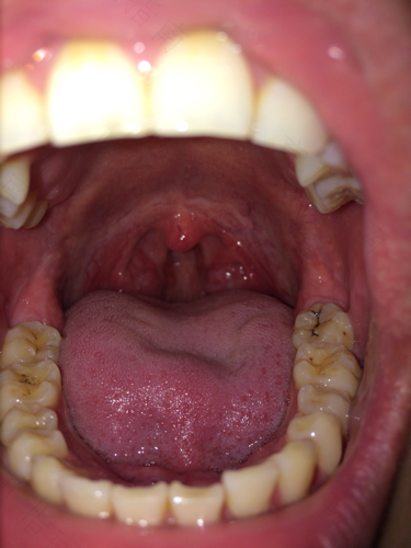 口腔白色念珠菌病的早期症状 口腔白色念珠菌病的早期症状