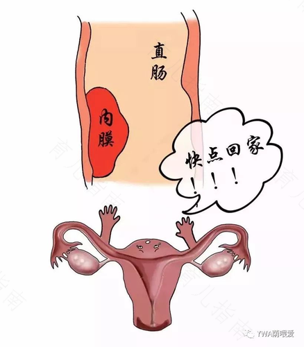 子宫内膜异位症疼 子宫内膜异位症疼