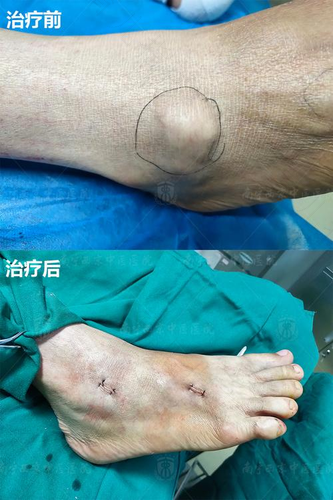 怎么知道得了痛风石