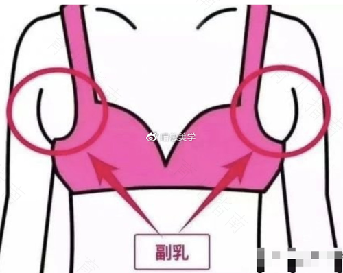 腋下淋巴副乳的危害 腋下淋巴副乳的危害
