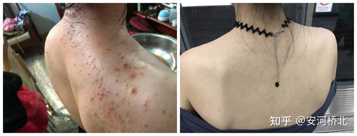 背上的痘痘怎么治疗 背上的痘痘怎么治疗