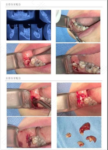 拔牙之后要疼多久 拔牙之后要疼多久