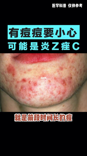 为什么脸上会有炎症 为什么脸上会有炎症