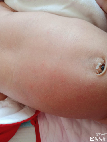 肚子长红点痒越来越多