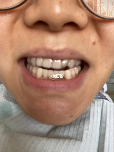 把牙磨小了好痛,怎么办