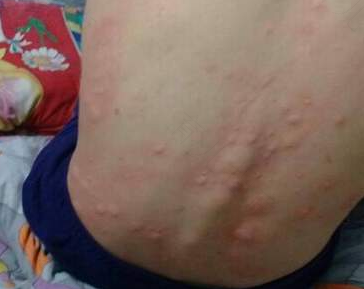 麻疹怎么治疗最快好