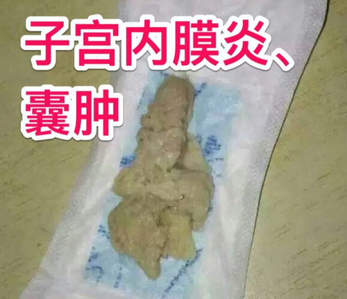 子宫内膜炎好了的症状