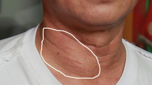 甲状腺结节发病的原因是什么