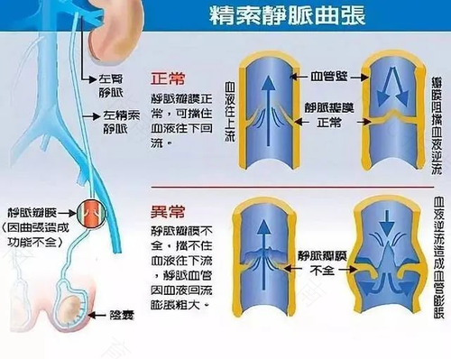 精索静脉扩张怎么回事