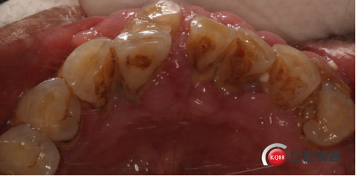 牙龈增生怎么办快速消除