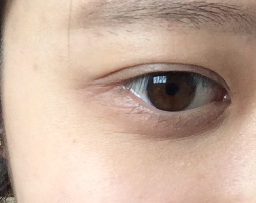 眼睛周围特别干怎么办 眼睛周围特别干怎么办