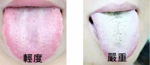 舌苔白有口臭怎么办 舌苔白有口臭怎么办