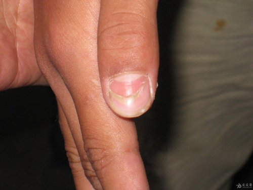 手指甲长畸形怎么办 手指甲长畸形怎么办