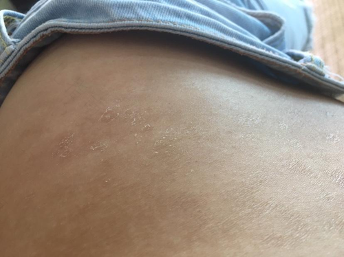 肚子上脱皮怎么回事 肚子上脱皮怎么回事