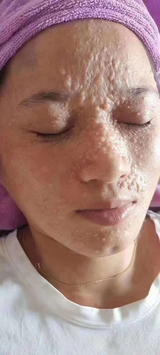 眼睛上的斑点怎么去除