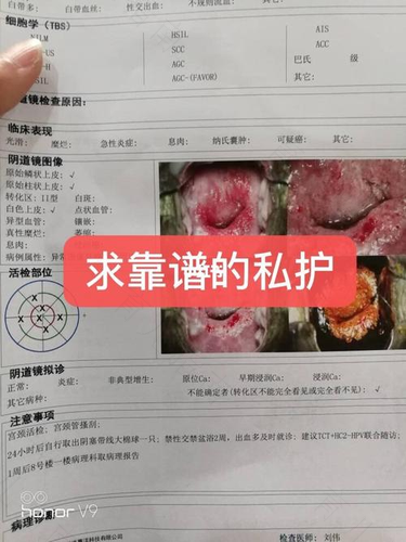 重度宫颈糜烂用什么方法治疗 重度宫颈糜烂用什么方法治疗