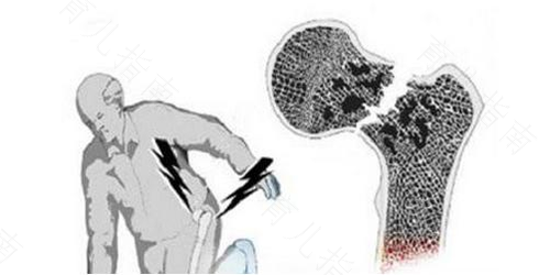 股骨头突然疼痛怎么办 股骨头突然疼痛怎么办