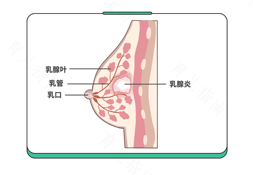 急性乳腺炎的病因有哪些 急性乳腺炎的病因有哪些