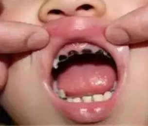 小孩乳牙老是不掉怎么办 小孩乳牙老是不掉怎么办