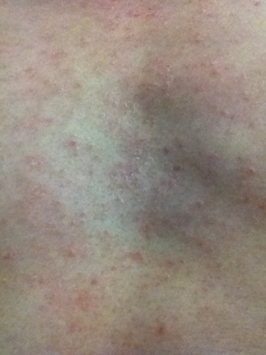 一个乳头很痒怎么回事 一个乳头很痒怎么回事