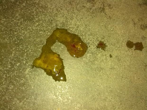 拉稀也便血是怎么回事 拉稀也便血是怎么回事