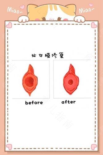 处女膜闭锁怎么办？