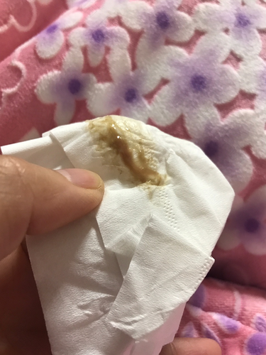 小肚子胀痛分泌物多怎么回事