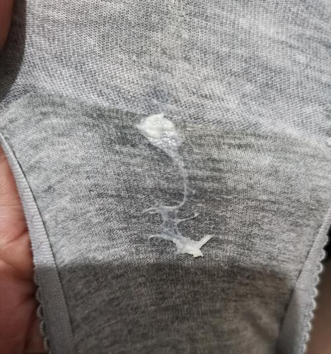 白带豆腐渣外阴瘙痒用什么药 白带豆腐渣外阴瘙痒用什么药