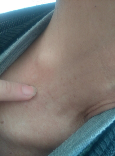 脖子囊肿怎么治疗最好 脖子囊肿怎么治疗最好