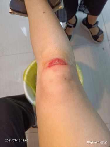 膝盖摔倒肿起来怎么办 膝盖摔倒肿起来怎么办