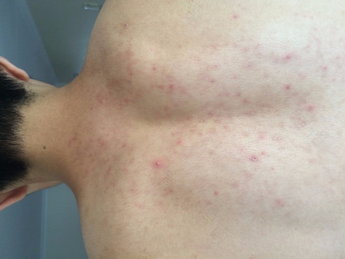 婴儿身上有干癣怎么办