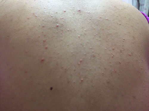 每天晚上后背痒是怎么回事 每天晚上后背痒是怎么回事