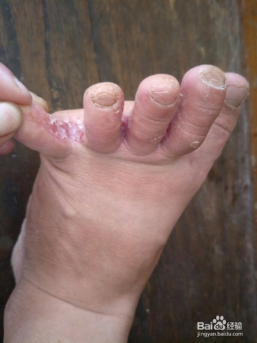 脚上脱皮痒是怎么回事 脚上脱皮痒是怎么回事