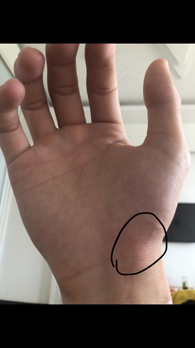 两个大拇指关节痛是怎么回事 两个大拇指关节痛是怎么回事