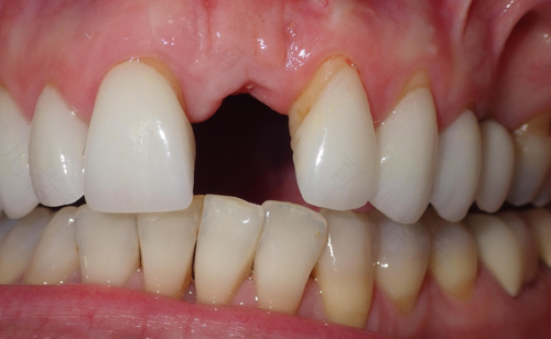 门牙摔断了怎么办要多少钱 门牙摔断了怎么办要多少钱