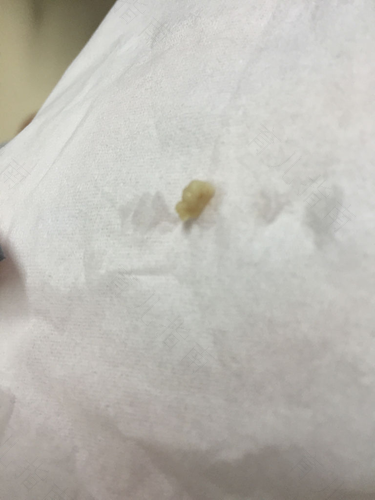 咽喉炎咳嗽有痰吗?