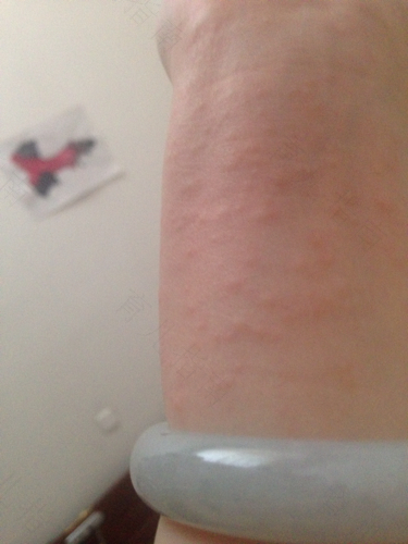 身上起红疙瘩很痒怎么办越挠越多用什么药 身上起红疙瘩很痒怎么办越挠越多用什么药