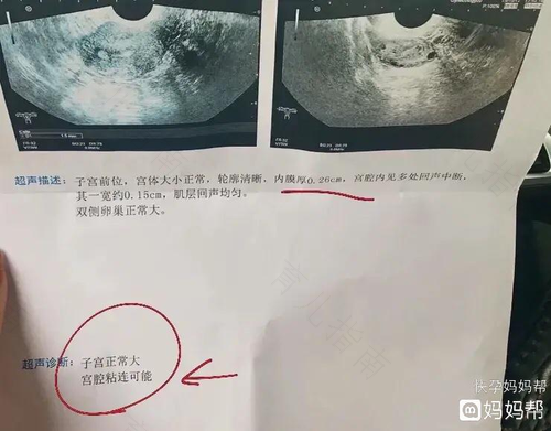 宫颈很厚是什么意思 宫颈很厚是什么意思