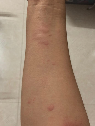 身体过敏起疙瘩怎么治图片 身体过敏起疙瘩怎么治图片