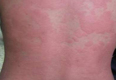 荨麻疹用什么洗澡最好 荨麻疹用什么洗澡最好