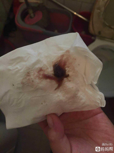 分泌物水样带血是什么原因 分泌物水样带血是什么原因