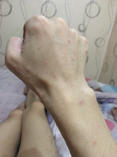 小红点变成小水泡是怎么回事 小红点变成小水泡是怎么回事