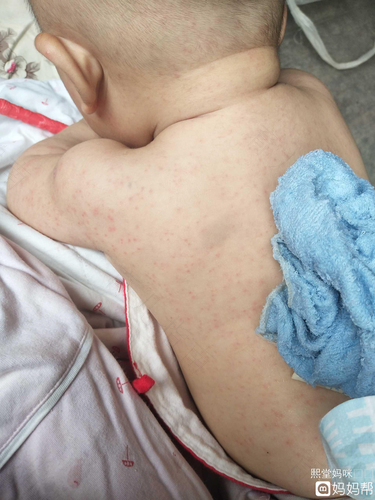 身上皮肤过敏红痒怎么办 身上皮肤过敏红痒怎么办