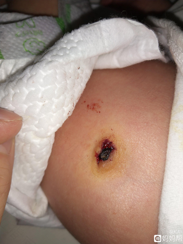 新生儿肚脐眼鼓出来了怎么办 新生儿肚脐眼鼓出来了怎么办