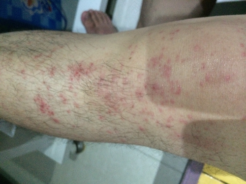 过敏全身发热怎么办 过敏全身发热怎么办