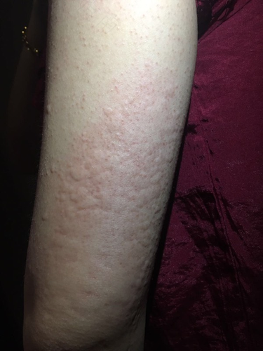 喝药过敏了身上痒怎么办